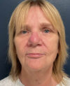 Facelift case #20023