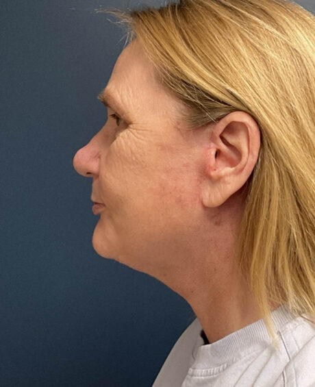Facelift case #20023