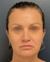 Facelift case #20143