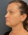 Facelift case #20143