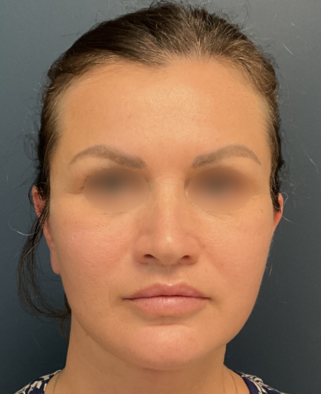 Facelift case #20143