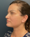 Facelift case #20143