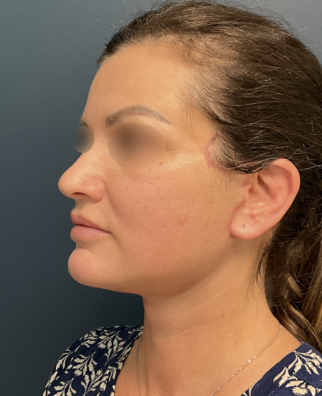 Facelift case #20143