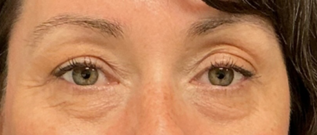 Eyelid Surgery case #20000