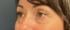 Eyelid Surgery case #20000