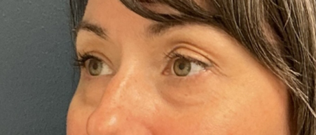 Eyelid Surgery case #20000
