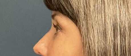 Eyelid Surgery case #20000
