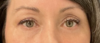 Eyelid Surgery case #20000