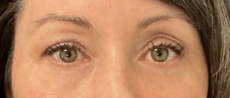 Eyelid Surgery case #20000