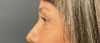 Eyelid Surgery case #20000