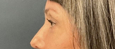 Eyelid Surgery case #20000