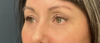 Eyelid Surgery case #20000