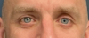 Eyelid Surgery case #20042