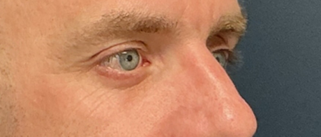 Eyelid Surgery case #20042
