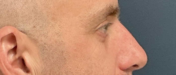 Eyelid Surgery case #20042
