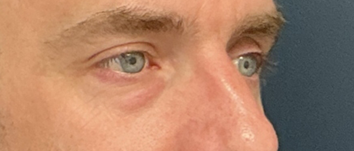 Eyelid Surgery case #20042