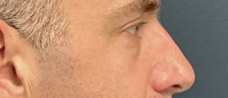 Eyelid Surgery case #20042