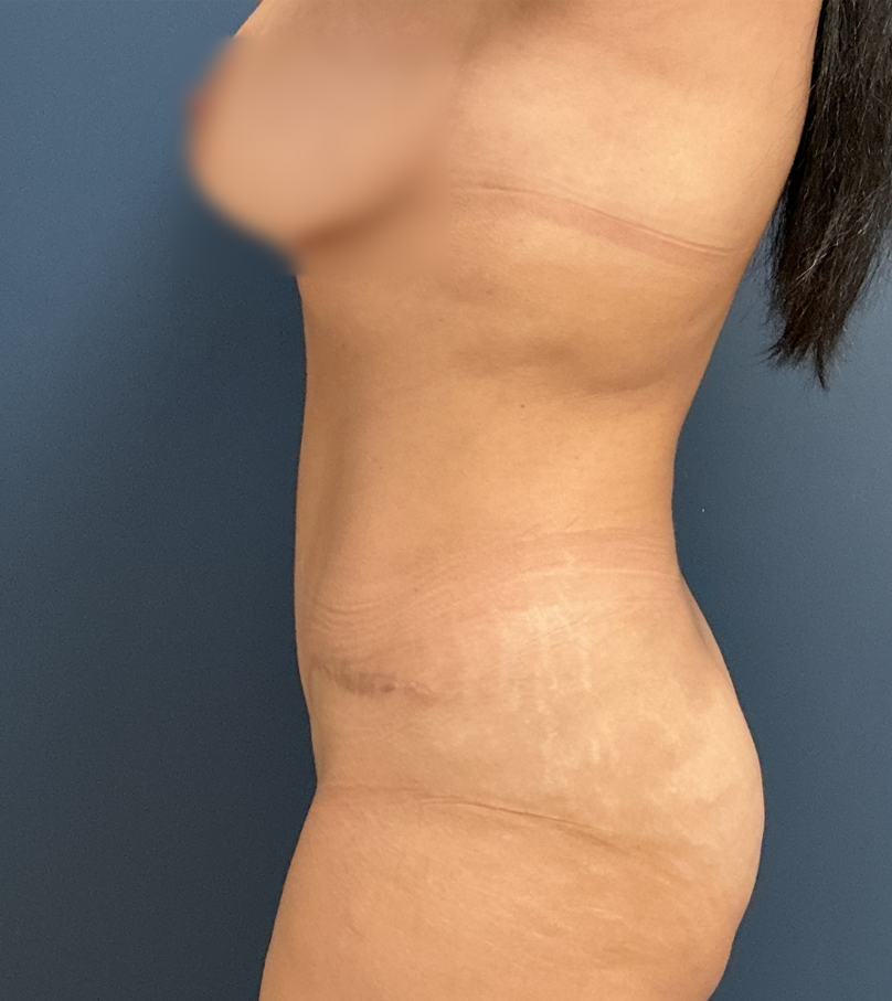 Tummy Tuck case #20079