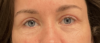 Eyelid Surgery case #20007