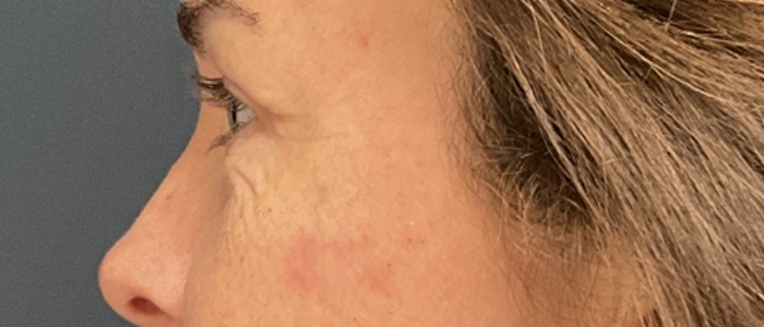 Eyelid Surgery case #20007