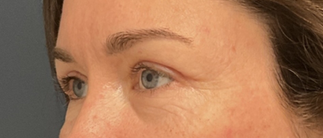 Eyelid Surgery case #20007