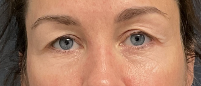 Eyelid Surgery case #20007