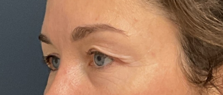 Eyelid Surgery case #20007