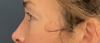 Eyelid Surgery case #20007