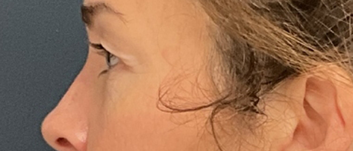 Eyelid Surgery case #20007