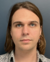 Facial Feminization Surgery case #20152