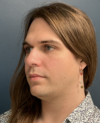 Facial Feminization Surgery case #20152