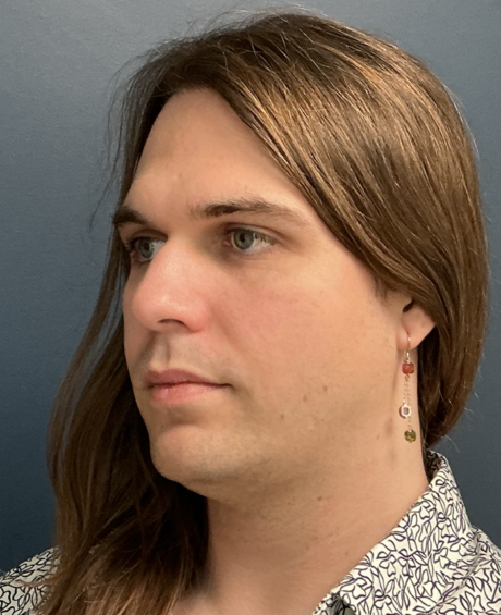 Facial Feminization Surgery case #20152