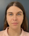 Facial Feminization Surgery case #20152