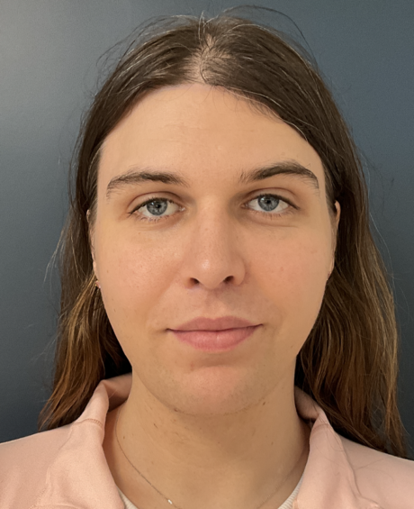 Facial Feminization Surgery case #20152