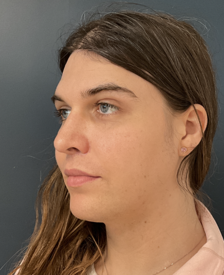 Facial Feminization Surgery case #20152