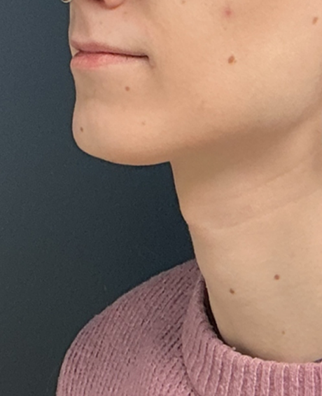 Facial Feminization Surgery case #20014