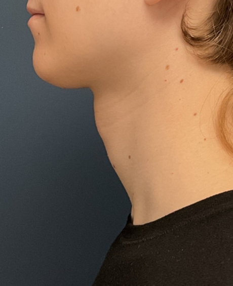 Facial Feminization Surgery case #20014
