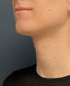 Facial Feminization Surgery case #20014