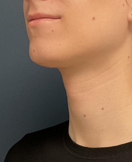 Facial Feminization Surgery case #20014