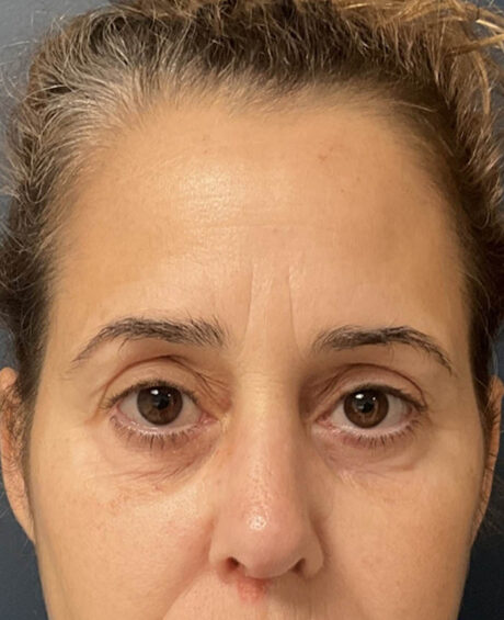 Brow lift case #20028