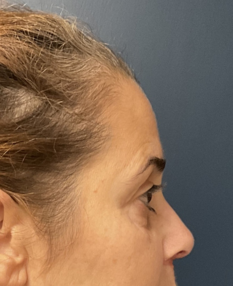 Brow lift case #20028
