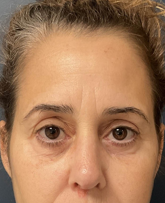 Brow lift case #20028