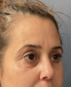 Brow lift case #20028