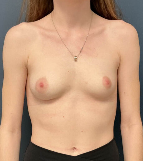 Breast Augmentation case #20563