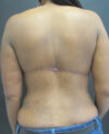 Mid Back lift case #20471