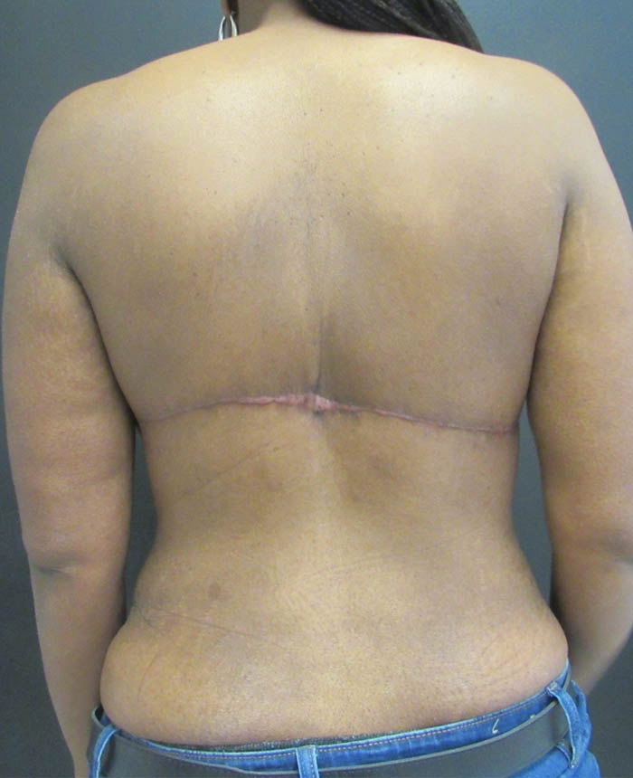 Mid Back lift case #20471