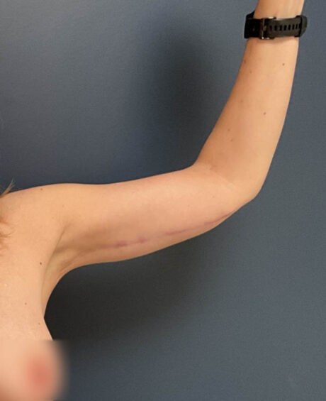 Arm Lift case #20551