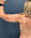 Arm Lift case #20551