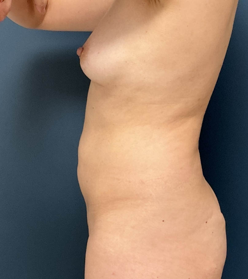 Tummy Tuck case #20571