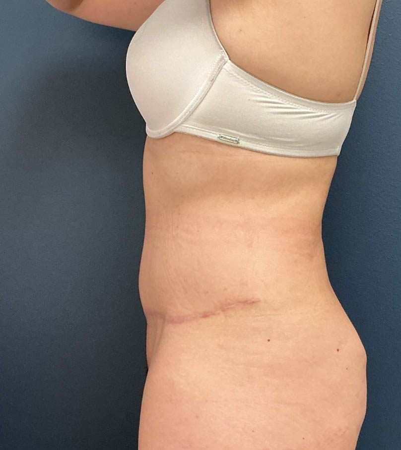 Tummy Tuck case #20571